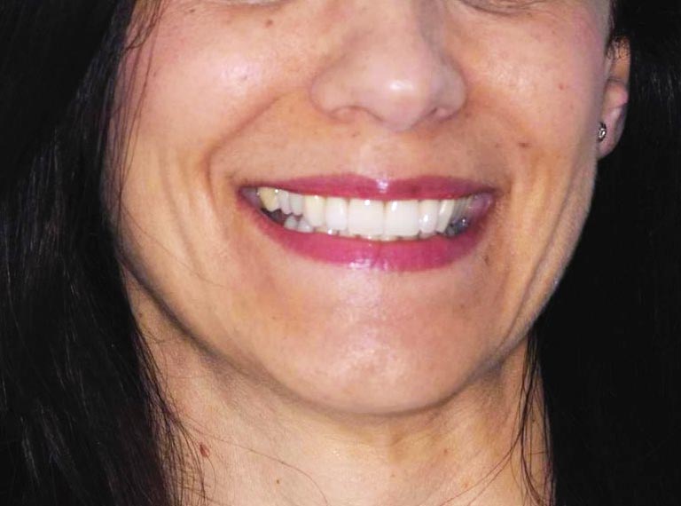 Faccette estetiche